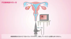 子宮鏡検査